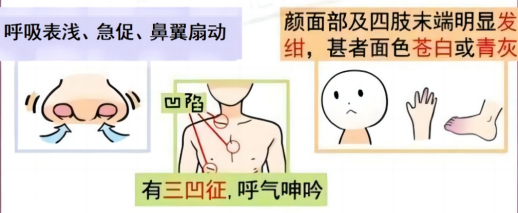 儿童呼吸道合胞病毒感染574.png