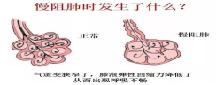 慢阻肺世界日活动297.png