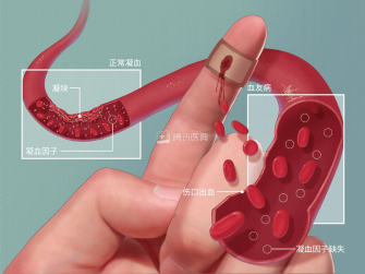 血友病--杨江权 -2360.png